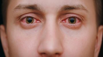 17 Penyebab Sakit Mata Merah dan Cara Mengatasinya
