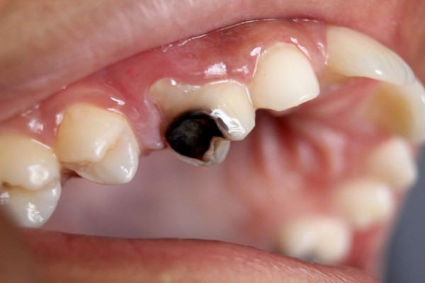 Penyebab Gigi Berlubang yang Perlu Diwaspadai