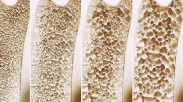 Mengenal Penyebab Tulang Keropos yang Dapat Dialami Segala Usia